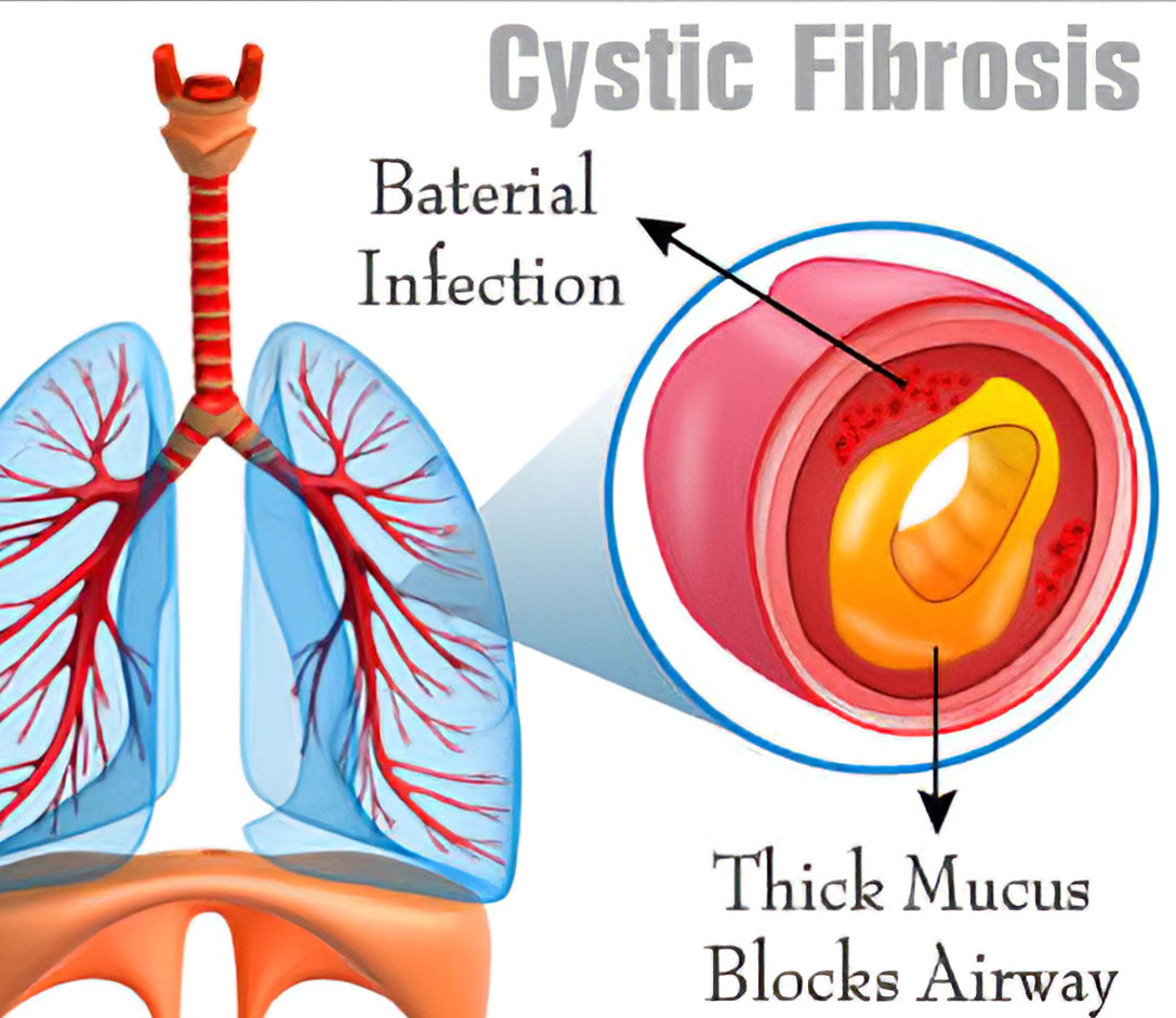 10 Symptoms of cystic fibrosis You Should Never Ignore
