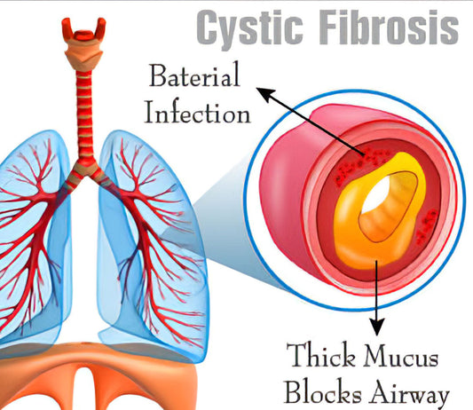 What is cystic fibrosis